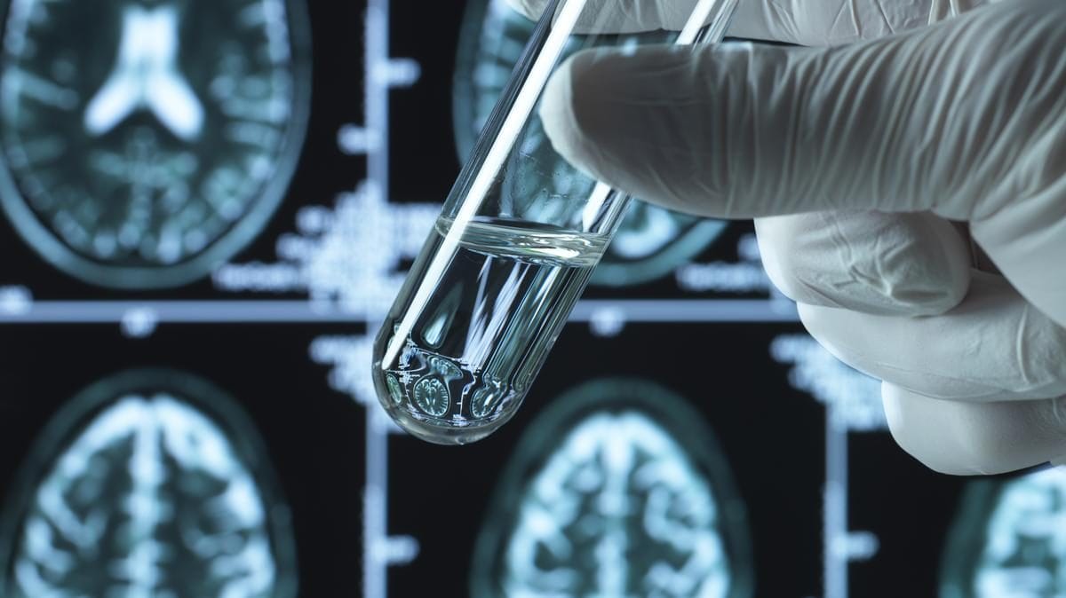 Az Alzheimer-kór altípusainak azonosítása forradalmi hatással lehet a kezelésre