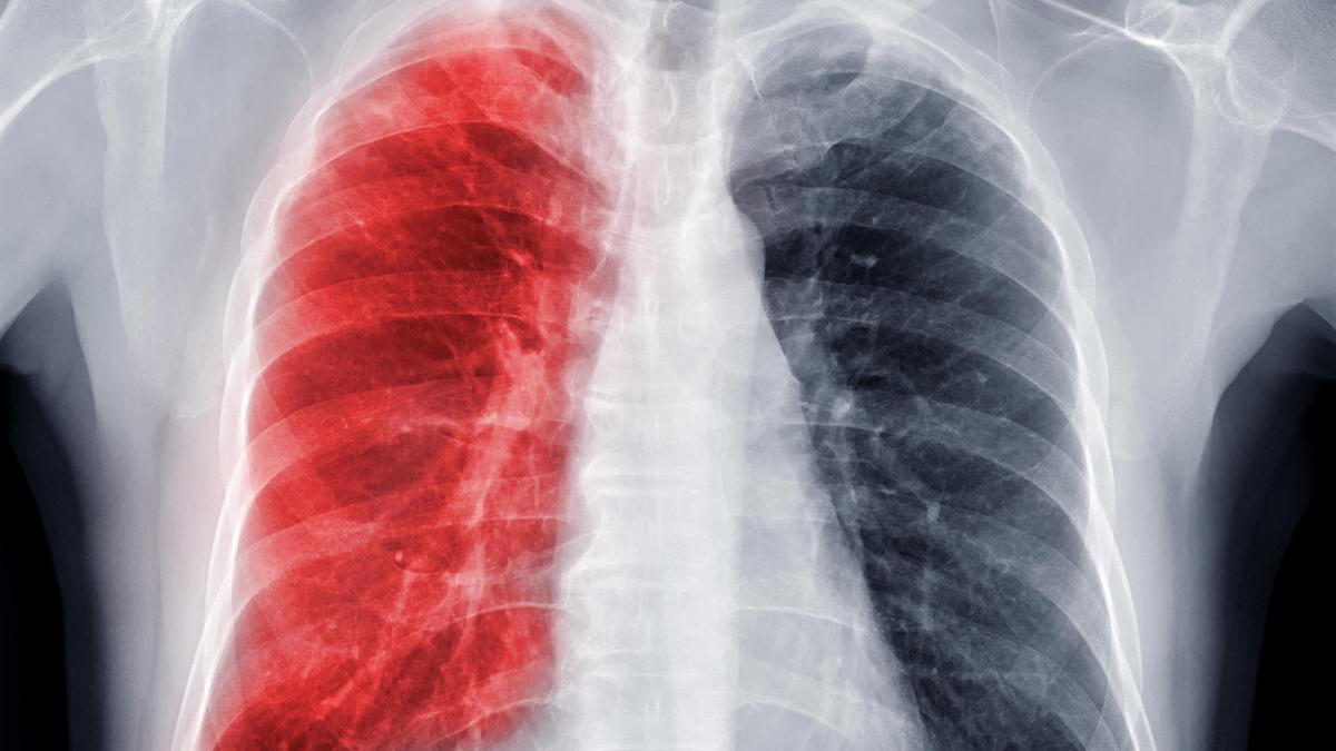 10 Meglepő Tény a Tuberkulózisról: Ezeket Ön Biztosan Nem Tudta