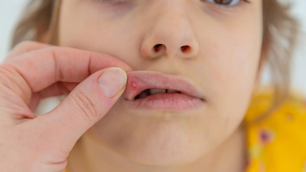 Afta kialakulásának lehetséges okai: a fogkrém is felelős lehet