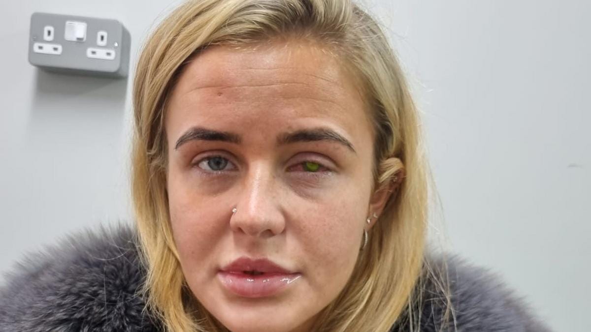 Döbbenetes eset: a kontaktlencse megvakította a fiatal lány egyik szemét – fotók