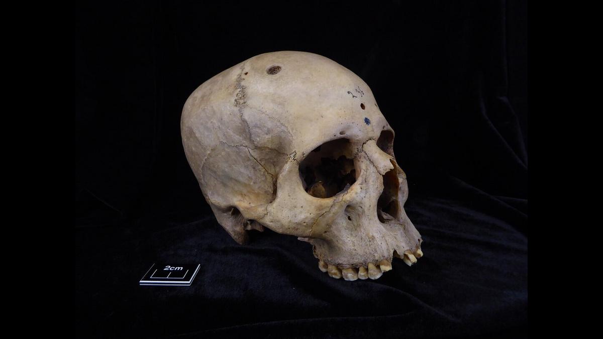 Az "Ősi orvosi csoda az ókori Egyiptomból: A 5000 éves műtött koponya rejtélye