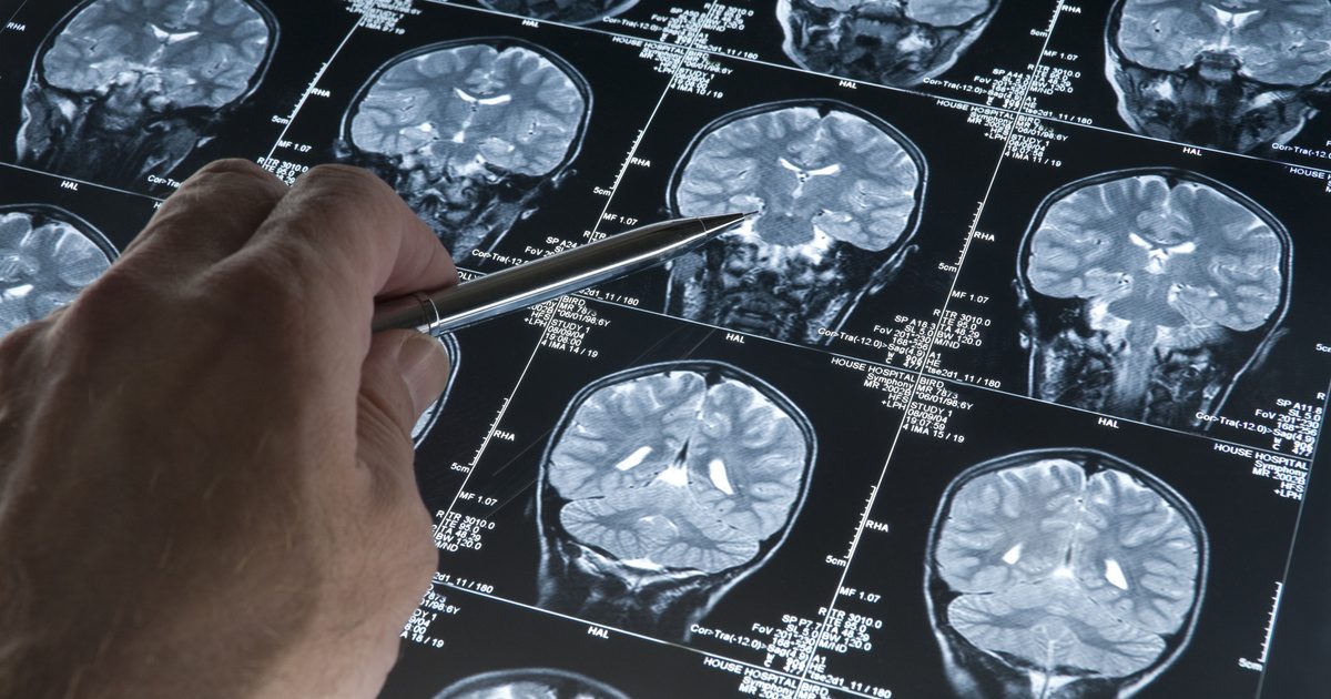 Az Alzheimer-kórt előre jelezheti ez a figyelemre méltó dolog még a tünetek megjelenése előtt: friss kutatás eredményei